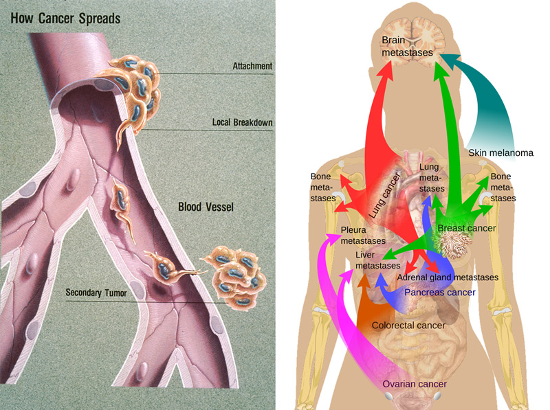 metastasis