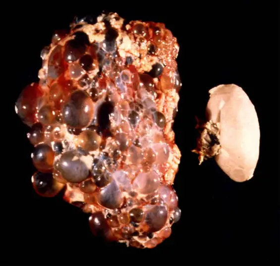 kidney cysts