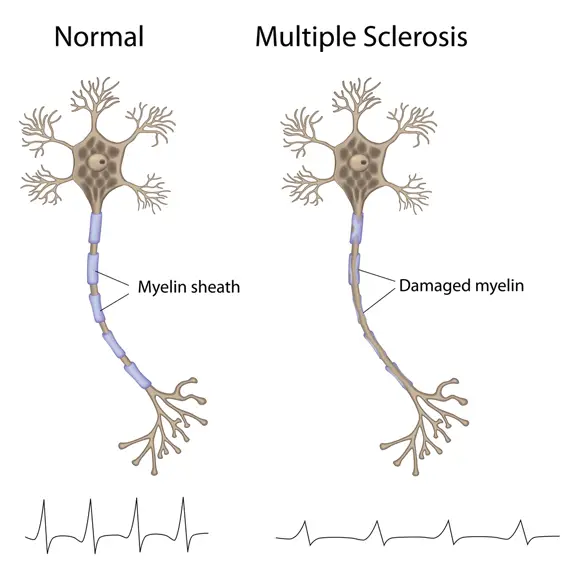 ms nerve diagram