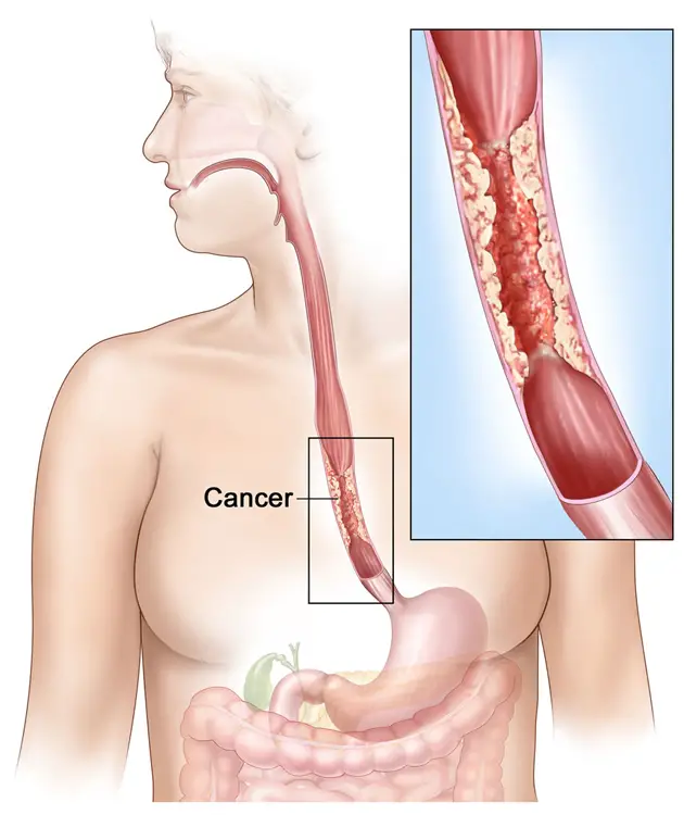 Esophageal cancer diagram