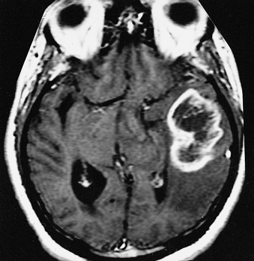 brain tumour glioblastoma multiforme gbm mri scan