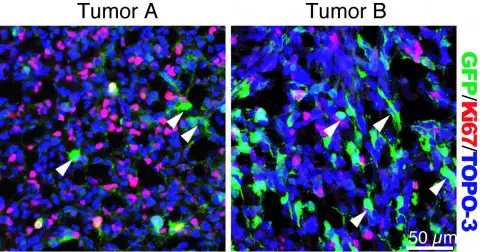 brain tumour cancer cells