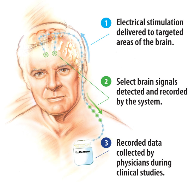 medtronic system