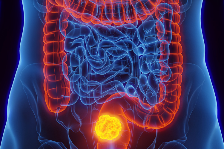 bowel cancer future timeline