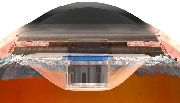 macular degeneration is curable