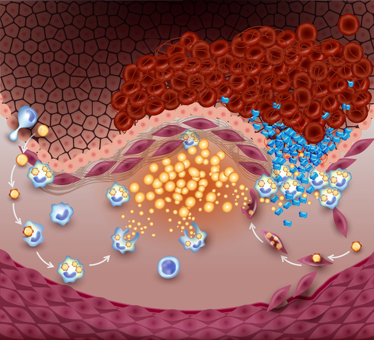 drug melts away fat inside arteries