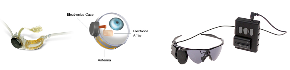 argus ii bionic eye