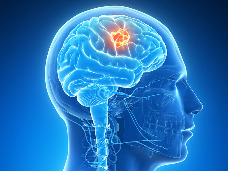 brain cancer breakthrough treatment future