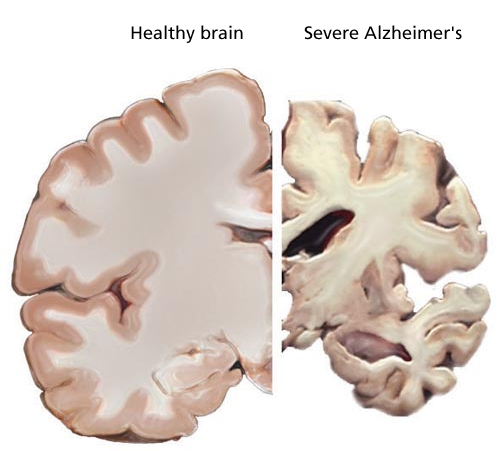 alzheimers brain