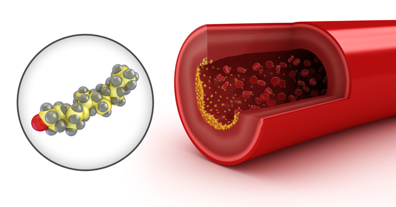 blood vessel plaque