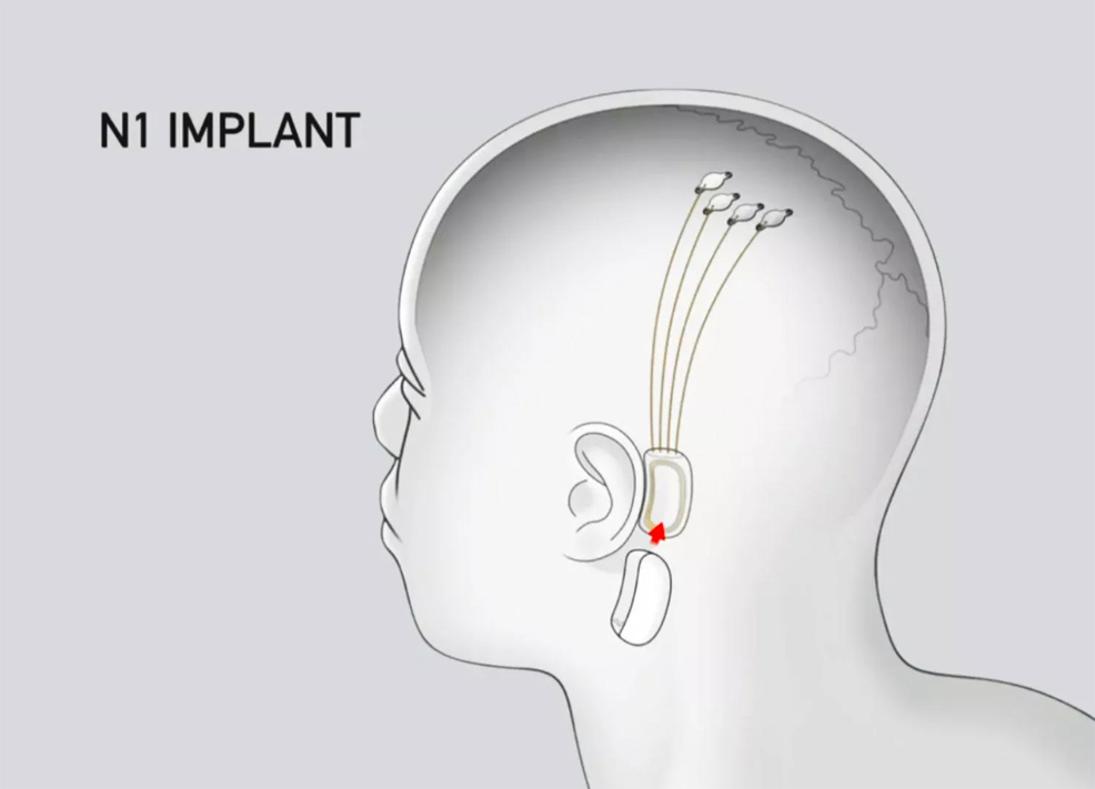 neuralink brain technology future timeline