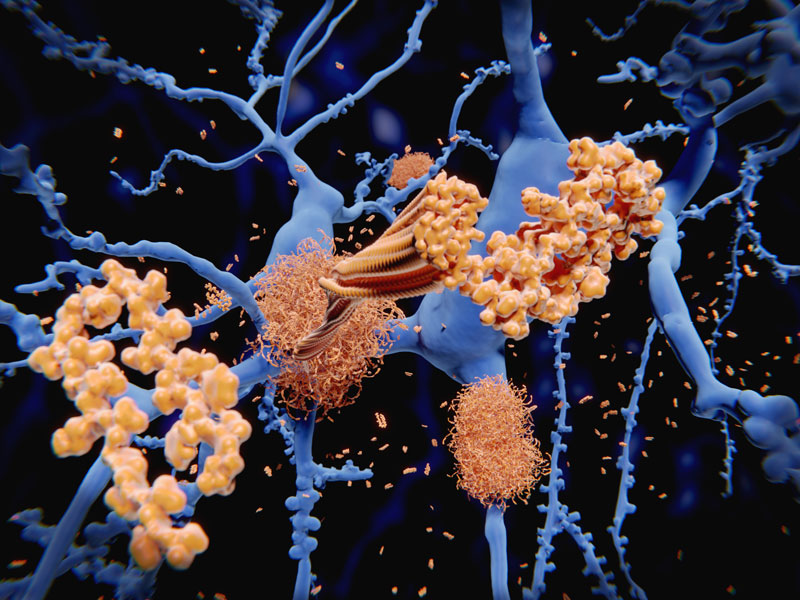 alzheimers disease future cure