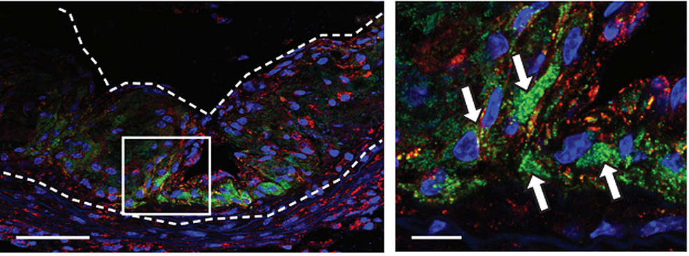 nanoparticles eating plaque