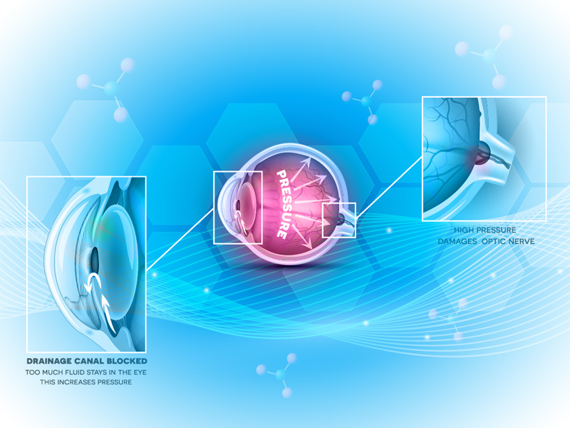 glaucoma gene therapy future