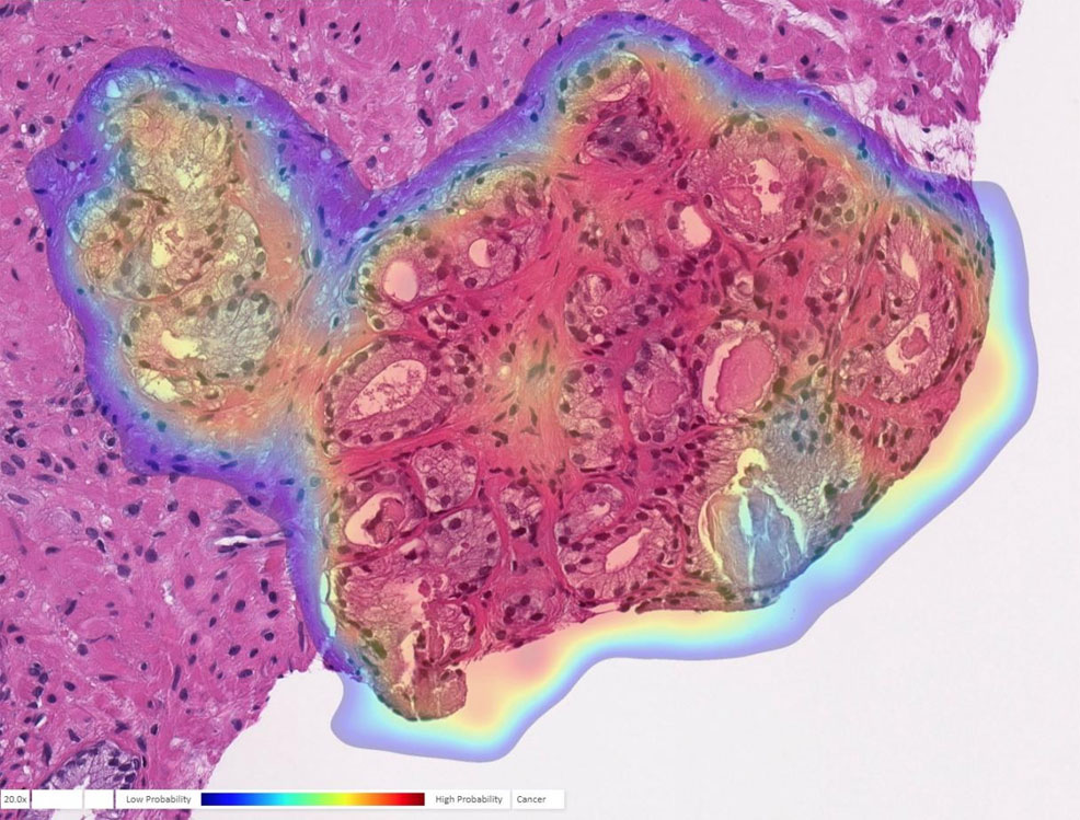 AI prostate cancer future timeline