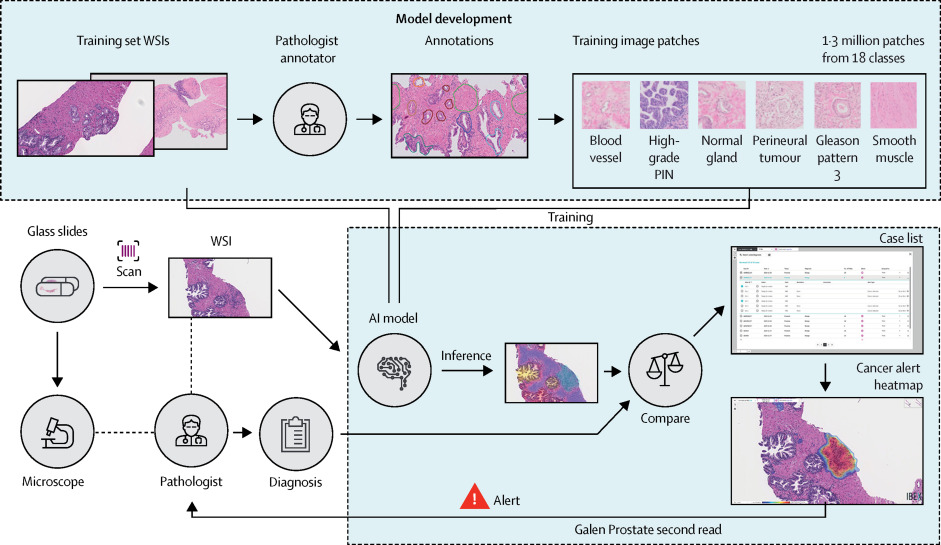 AI prostate cancer future timeline