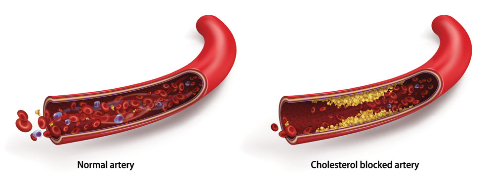 cholesterol lipid nanoparticle
