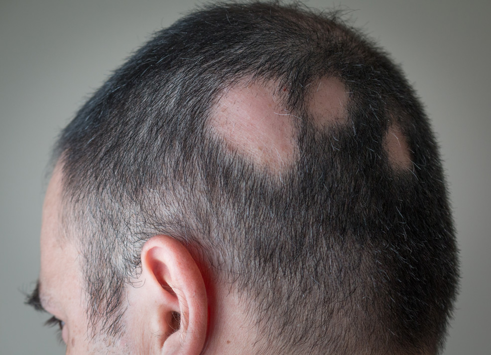 new drug for hair loss approved fda