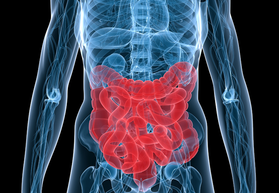 bowel cancer diagram