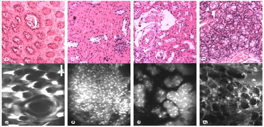 pen-sized microscope identifies cancer cells