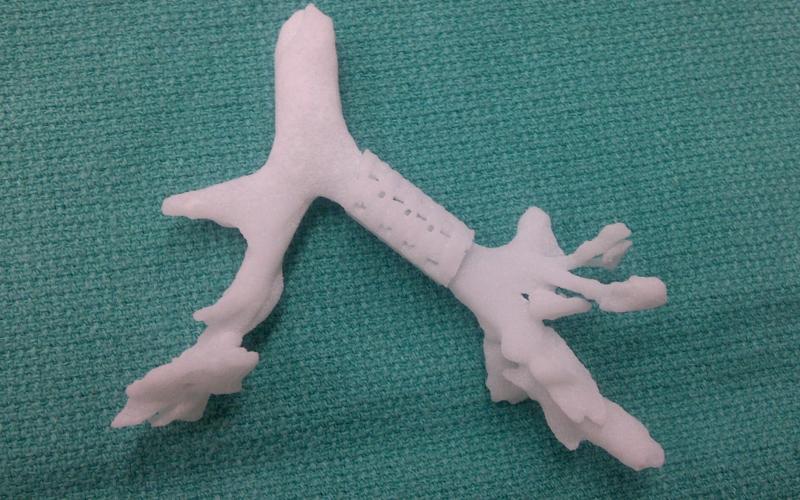 babys life saved with 3d printed device