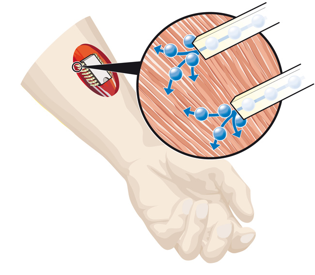 implant