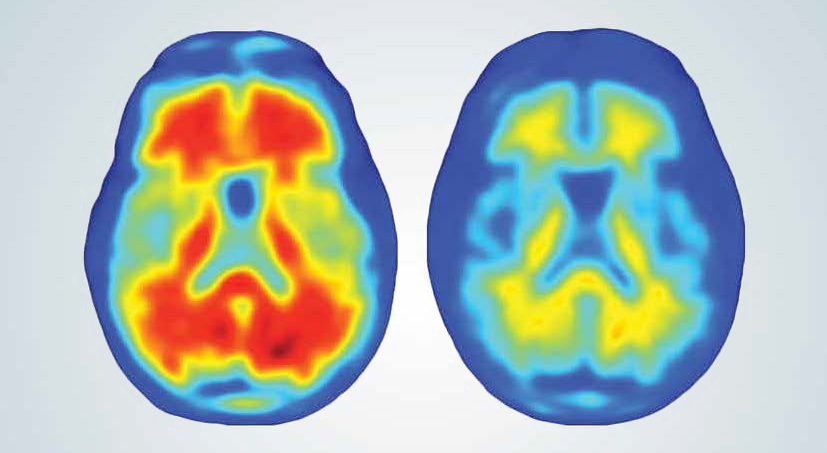promising new treatment for alzheimers