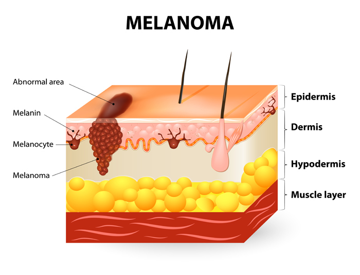 melanoma