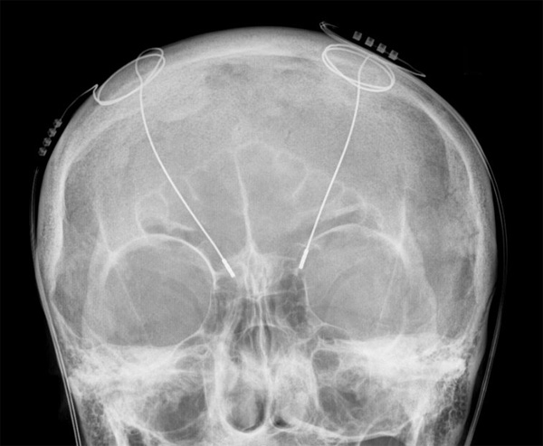 deep brain stimulation dbs