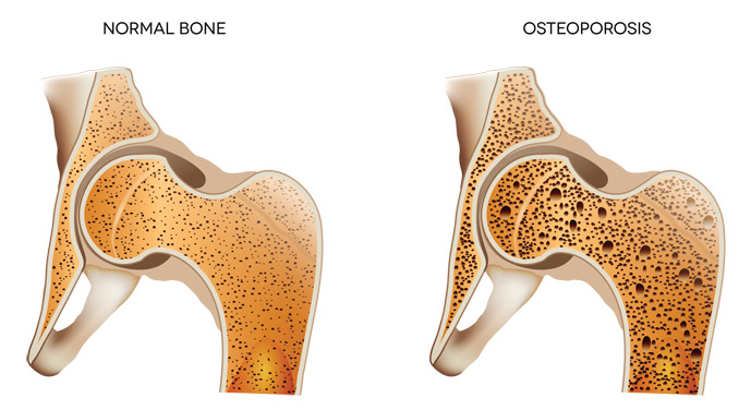 osteoporosis