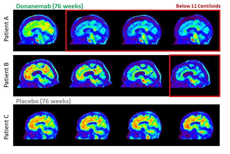 alzheimers future predictions