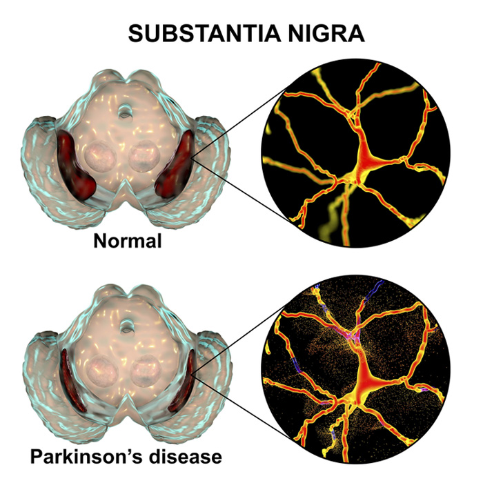 artificial intelligence parkinsons disease